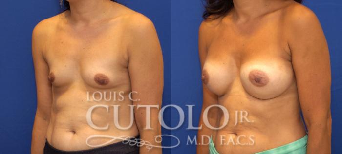 Before & After Breast Augmentation Case 120 View #2 View in Brooklyn, Staten Island, Queens, NY