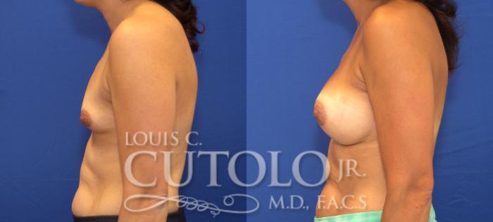 Before & After Breast Augmentation Case 120 View #3 View in Brooklyn, Staten Island, Queens, NY