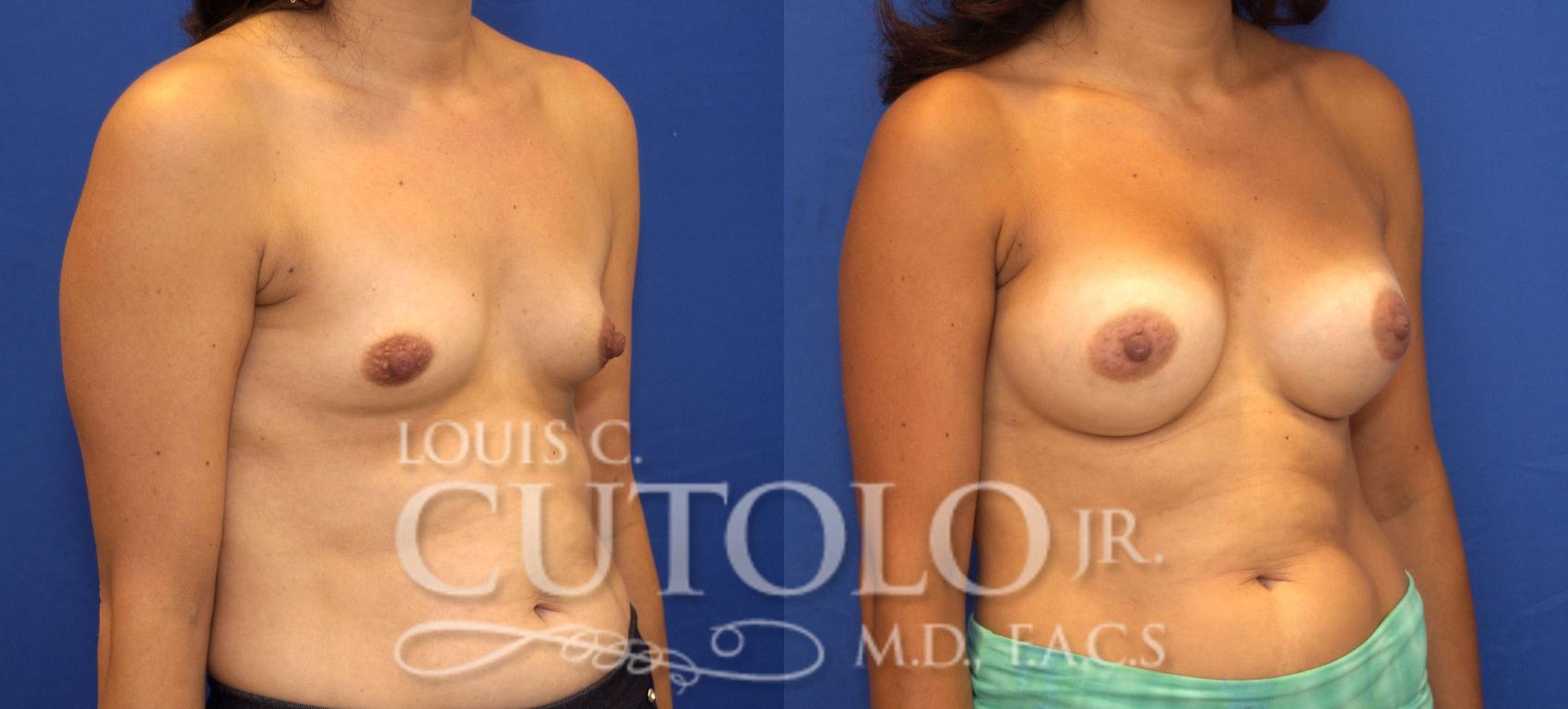 Before & After Breast Augmentation Case 120 View #4 View in Brooklyn, Staten Island, Queens, NY