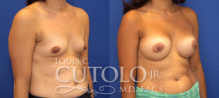 Before & After Breast Augmentation Case 120 View #4 View in Brooklyn, Staten Island, Queens, NY