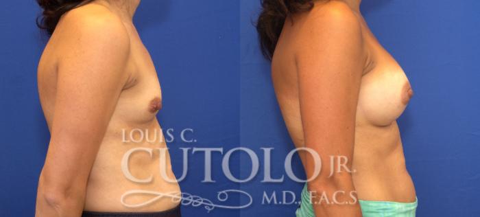 Before & After Breast Augmentation Case 120 View #5 View in Brooklyn, Staten Island, Queens, NY