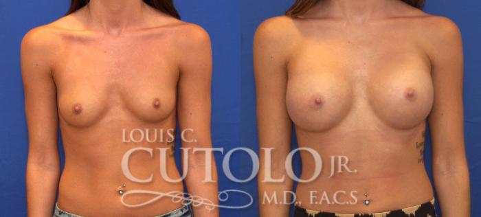 Before & After Breast Augmentation Case 122 View #1 View in Brooklyn, Staten Island, Queens, NY