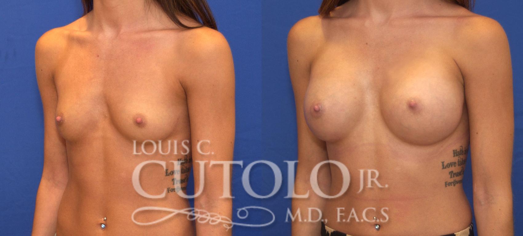 Before & After Breast Augmentation Case 122 View #2 View in Brooklyn, Staten Island, Queens, NY