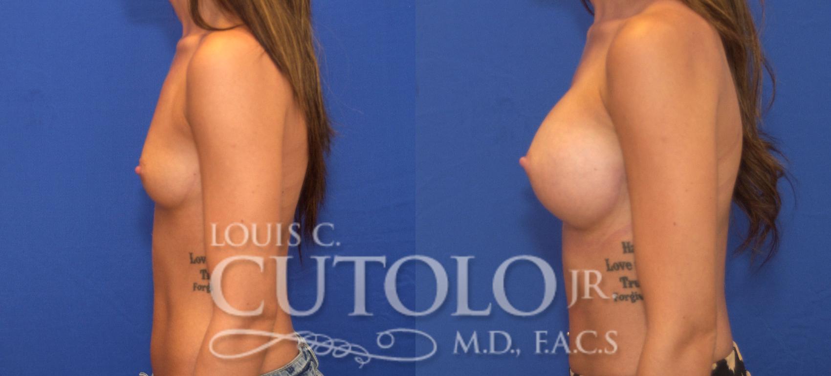 Before & After Breast Augmentation Case 122 View #3 View in Brooklyn, Staten Island, Queens, NY