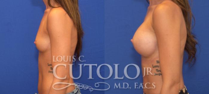 Before & After Breast Augmentation Case 122 View #3 View in Brooklyn, Staten Island, Queens, NY