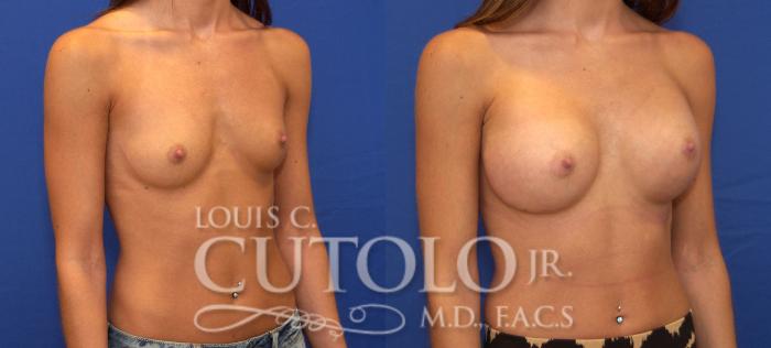 Before & After Breast Augmentation Case 122 View #4 View in Brooklyn, Staten Island, Queens, NY