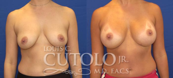 Before & After Breast Augmentation Case 123 View #1 View in Brooklyn, Staten Island, Queens, NY