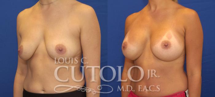 Before & After Breast Augmentation Case 123 View #2 View in Brooklyn, Staten Island, Queens, NY