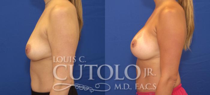 Before & After Breast Augmentation Case 123 View #3 View in Brooklyn, Staten Island, Queens, NY