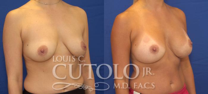 Before & After Breast Augmentation Case 123 View #4 View in Brooklyn, Staten Island, Queens, NY