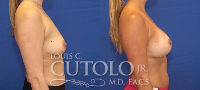 Before & After Breast Augmentation Case 123 View #5 View in Brooklyn, Staten Island, Queens, NY
