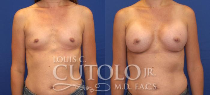 Before & After Breast Augmentation Case 124 View #1 View in Brooklyn, Staten Island, Queens, NY
