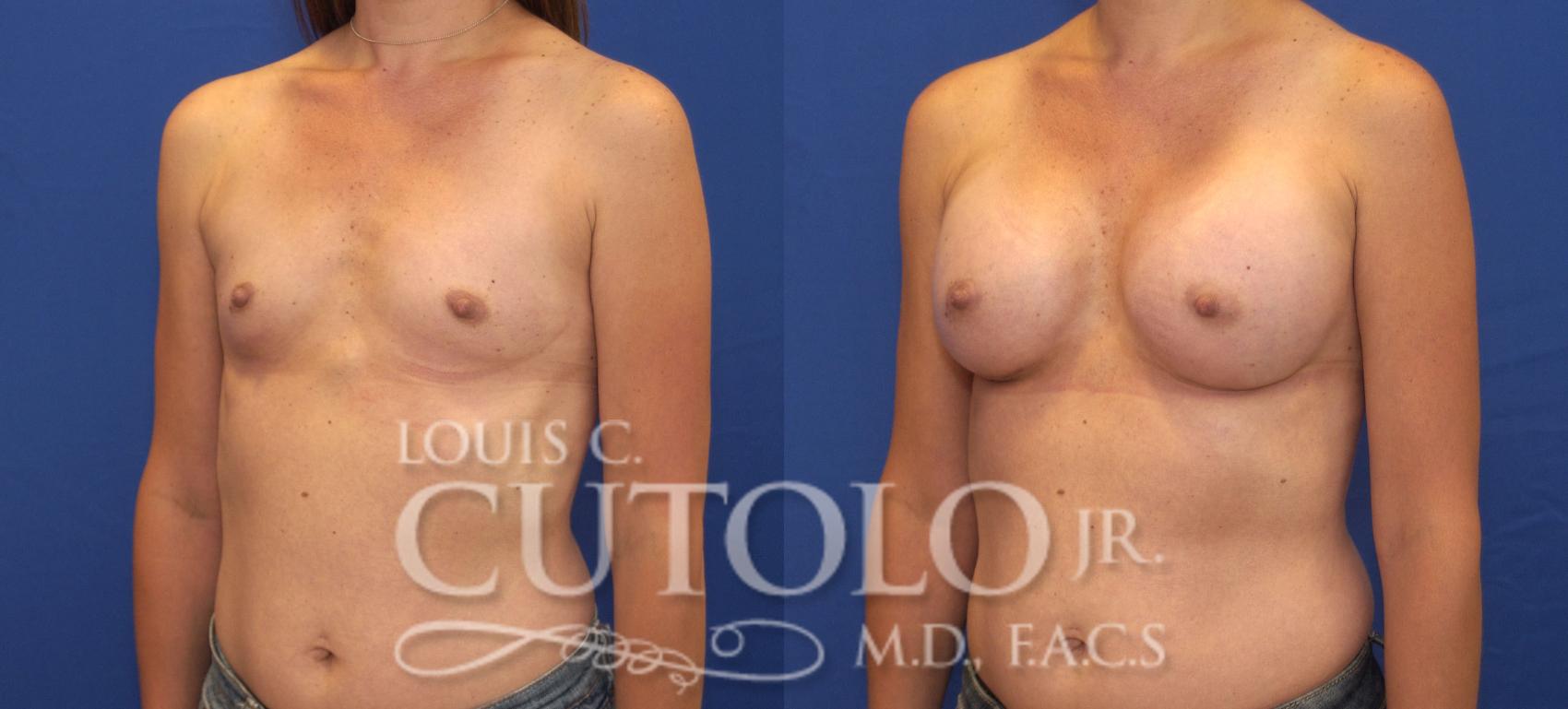 Before & After Breast Augmentation Case 124 View #2 View in Brooklyn, Staten Island, Queens, NY