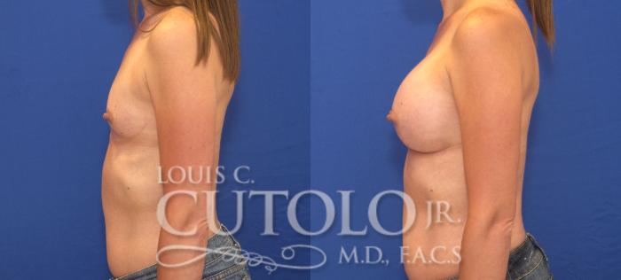 Before & After Breast Augmentation Case 124 View #3 View in Brooklyn, Staten Island, Queens, NY