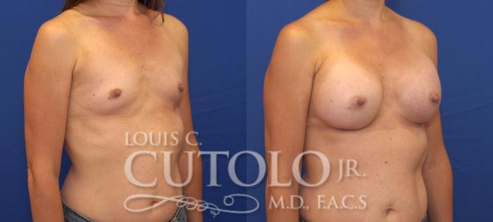 Before & After Breast Augmentation Case 124 View #4 View in Brooklyn, Staten Island, Queens, NY