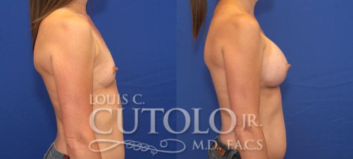 Before & After Breast Augmentation Case 124 View #5 View in Brooklyn, Staten Island, Queens, NY