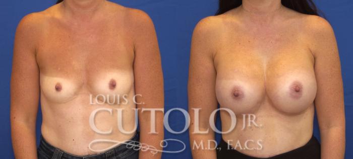 Before & After Breast Augmentation Case 129 View #1 View in Brooklyn, Staten Island, Queens, NY