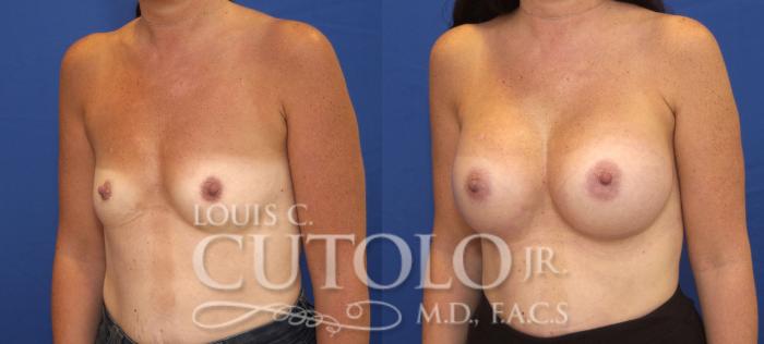 Before & After Breast Augmentation Case 129 View #2 View in Brooklyn, Staten Island, Queens, NY
