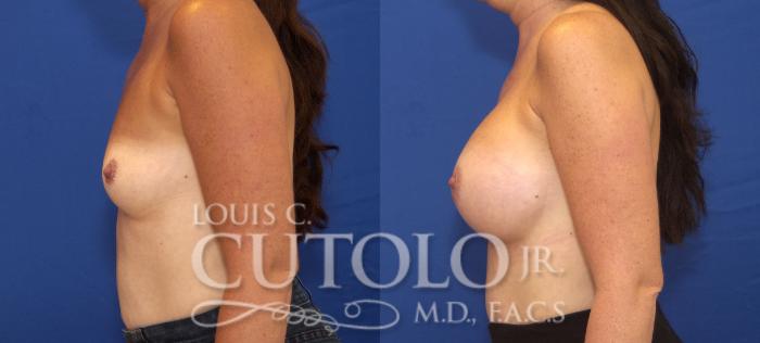 Before & After Breast Augmentation Case 129 View #3 View in Brooklyn, Staten Island, Queens, NY