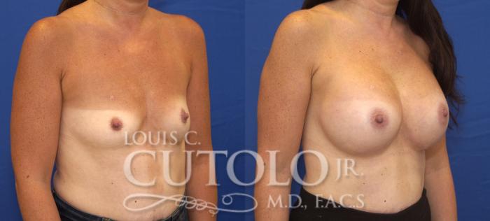 Before & After Breast Augmentation Case 129 View #4 View in Brooklyn, Staten Island, Queens, NY
