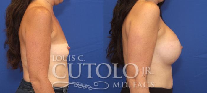 Before & After Breast Augmentation Case 129 View #5 View in Brooklyn, Staten Island, Queens, NY