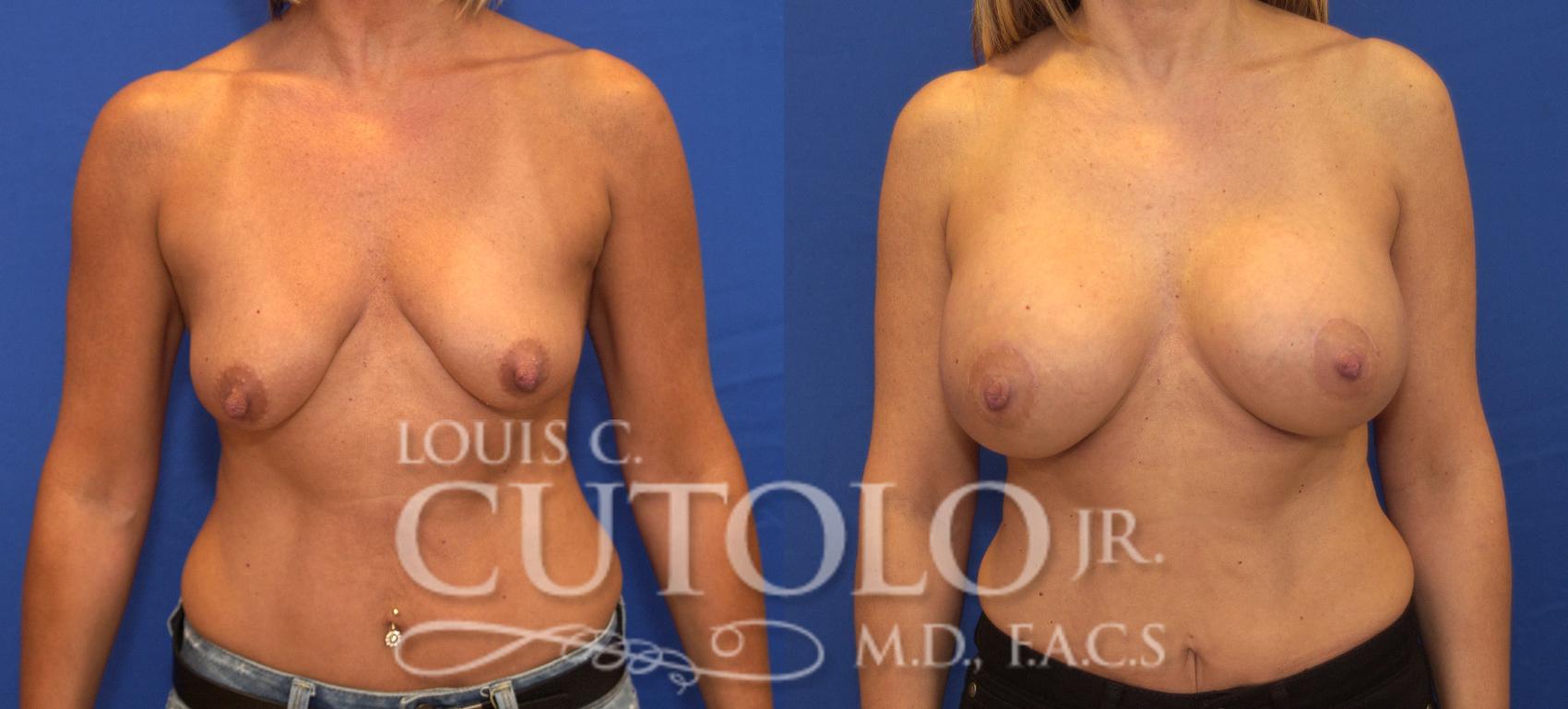 Before & After Breast Augmentation Case 130 View #1 View in Brooklyn, Staten Island, Queens, NY