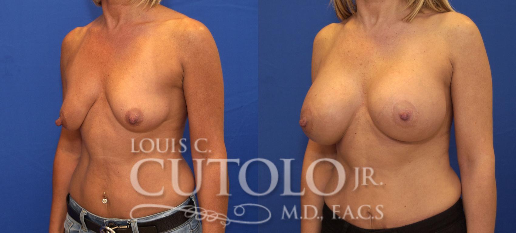 Before & After Breast Augmentation Case 130 View #2 View in Brooklyn, Staten Island, Queens, NY