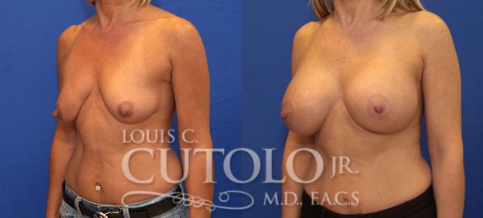 Before & After Breast Augmentation Case 130 View #2 View in Brooklyn, Staten Island, Queens, NY
