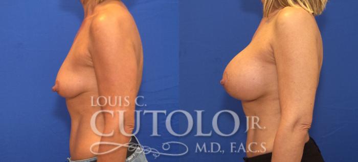 Before & After Breast Augmentation Case 130 View #3 View in Brooklyn, Staten Island, Queens, NY