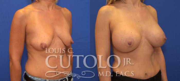 Before & After Breast Augmentation Case 130 View #4 View in Brooklyn, Staten Island, Queens, NY