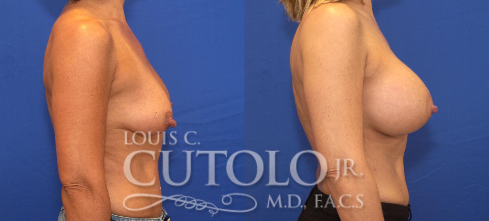 Before & After Breast Augmentation Case 130 View #5 View in Brooklyn, Staten Island, Queens, NY