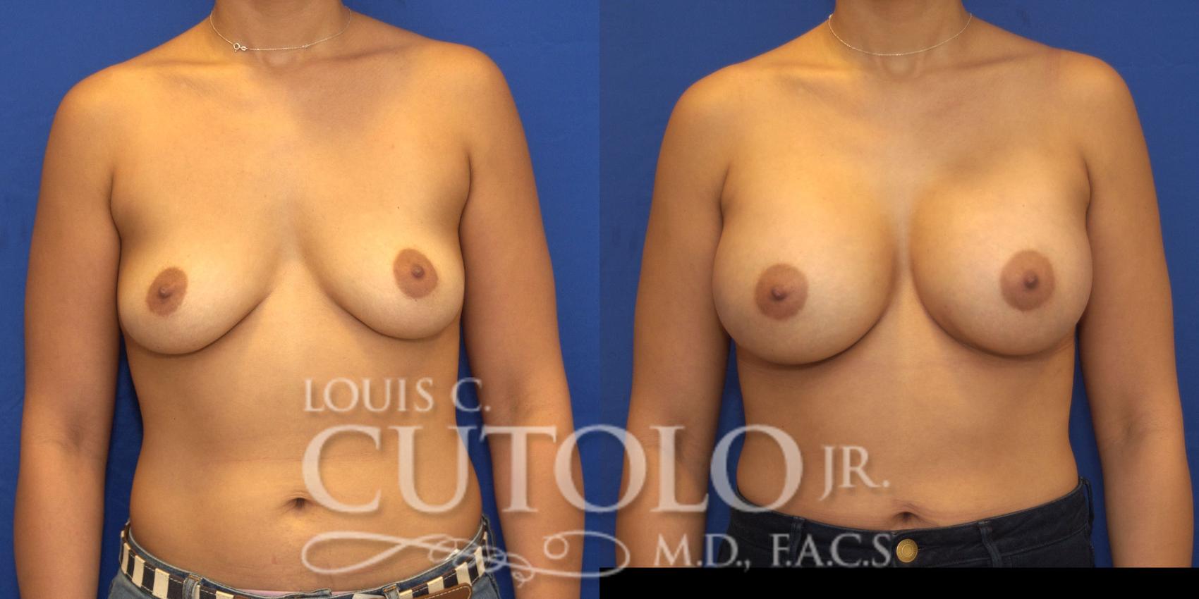 Before & After Breast Augmentation Case 131 View #1 View in Brooklyn, Staten Island, Queens, NY