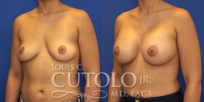 Before & After Breast Augmentation Case 131 View #2 View in Brooklyn, Staten Island, Queens, NY