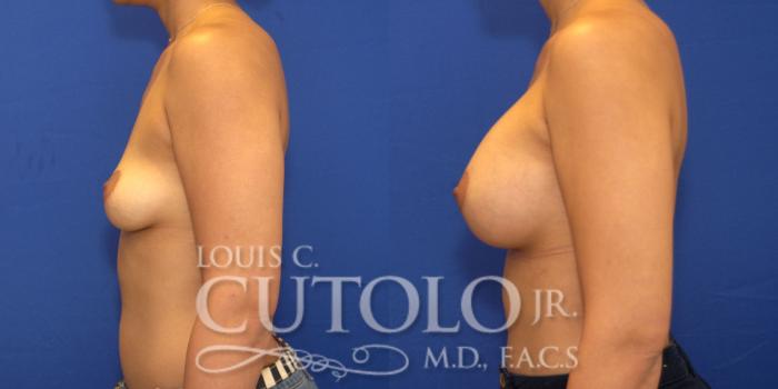 Before & After Breast Augmentation Case 131 View #3 View in Brooklyn, Staten Island, Queens, NY