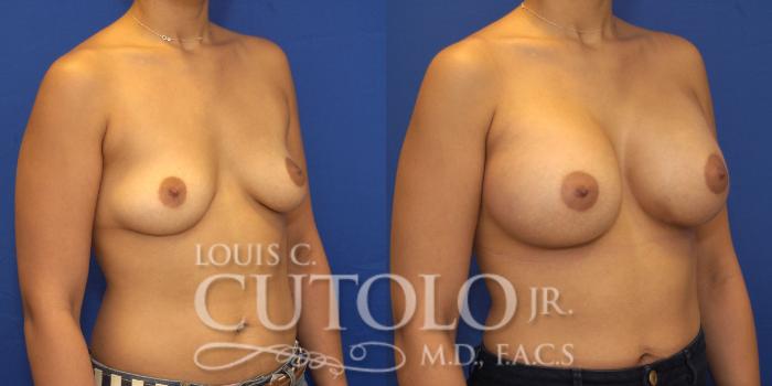 Before & After Breast Augmentation Case 131 View #4 View in Brooklyn, Staten Island, Queens, NY