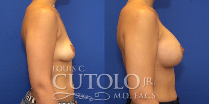 Before & After Breast Augmentation Case 131 View #5 View in Brooklyn, Staten Island, Queens, NY