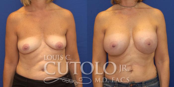 Before & After Breast Augmentation Case 132 View #1 View in Brooklyn, Staten Island, Queens, NY