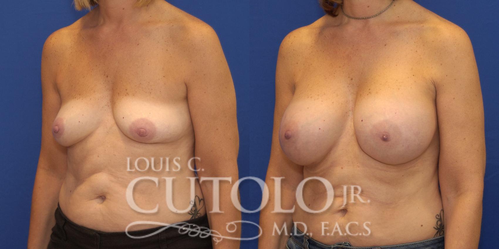 Before & After Breast Augmentation Case 132 View #2 View in Brooklyn, Staten Island, Queens, NY