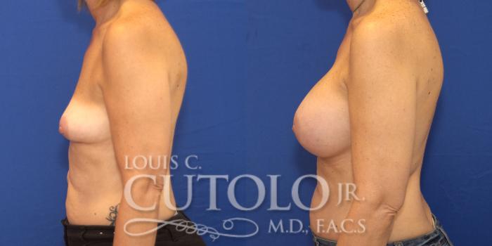 Before & After Breast Augmentation Case 132 View #3 View in Brooklyn, Staten Island, Queens, NY