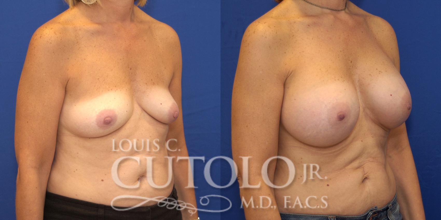 Before & After Breast Augmentation Case 132 View #4 View in Brooklyn, Staten Island, Queens, NY