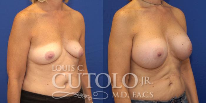 Before & After Breast Augmentation Case 132 View #4 View in Brooklyn, Staten Island, Queens, NY