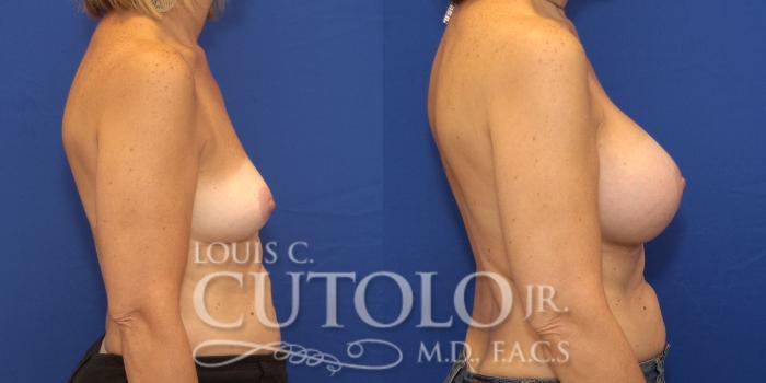 Before & After Breast Augmentation Case 132 View #5 View in Brooklyn, Staten Island, Queens, NY