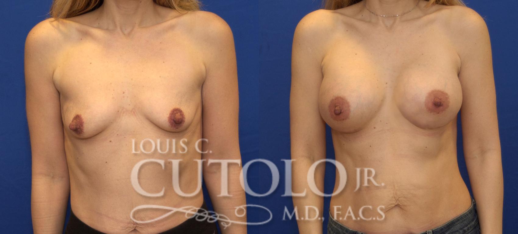 Before & After Breast Augmentation Case 136 View #1 View in Brooklyn, Staten Island, Queens, NY