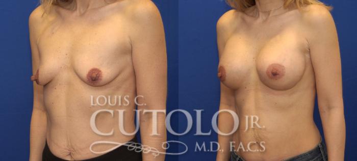 Before & After Breast Augmentation Case 136 View #2 View in Brooklyn, Staten Island, Queens, NY