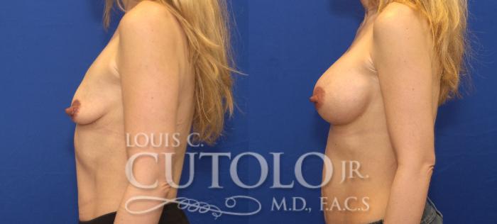 Before & After Breast Augmentation Case 136 View #3 View in Brooklyn, Staten Island, Queens, NY