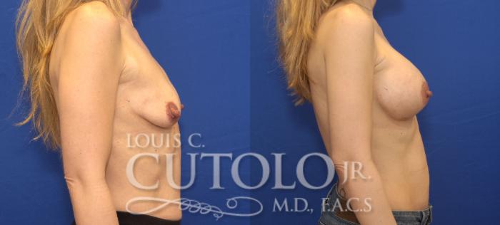 Before & After Breast Augmentation Case 136 View #5 View in Brooklyn, Staten Island, Queens, NY