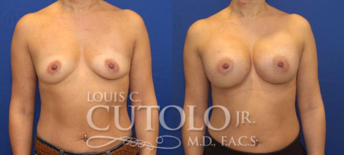 Before & After Breast Augmentation Case 137 View #1 View in Brooklyn, Staten Island, Queens, NY