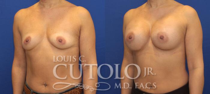 Before & After Breast Augmentation Case 137 View #2 View in Brooklyn, Staten Island, Queens, NY