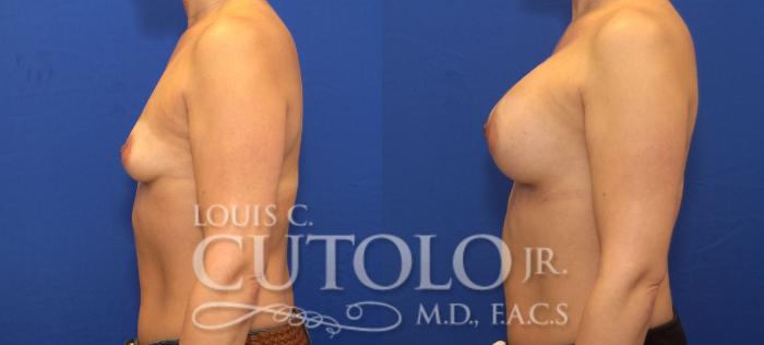 Before & After Breast Augmentation Case 137 View #3 View in Brooklyn, Staten Island, Queens, NY