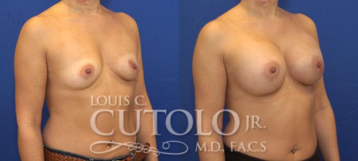 Before & After Breast Augmentation Case 137 View #4 View in Brooklyn, Staten Island, Queens, NY